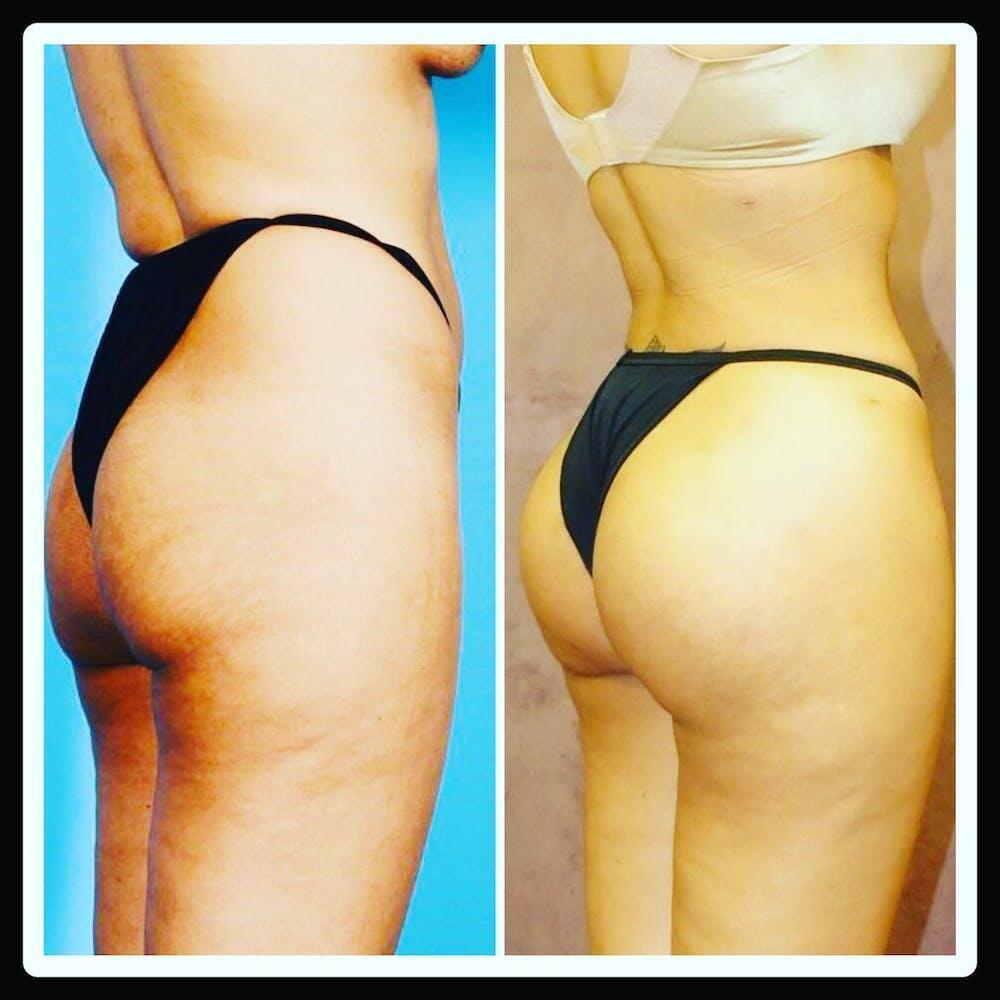 Brazilian Butt Lift Before & After Image