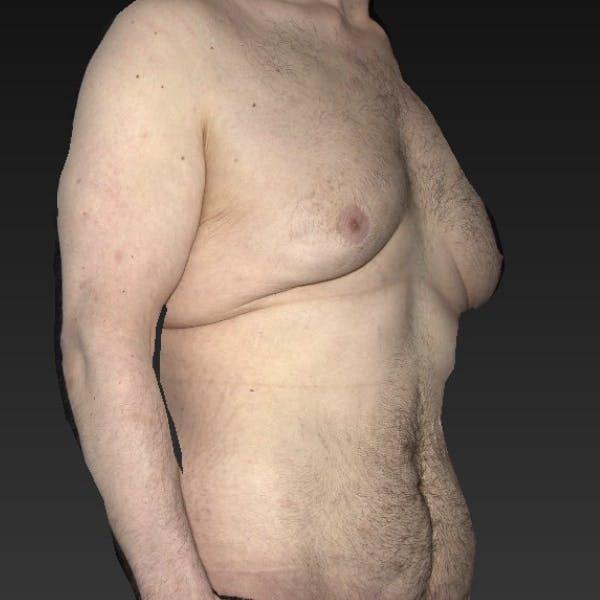 Gynecomastia Before & After Image