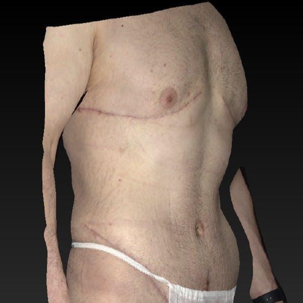 Gynecomastia Before & After Image