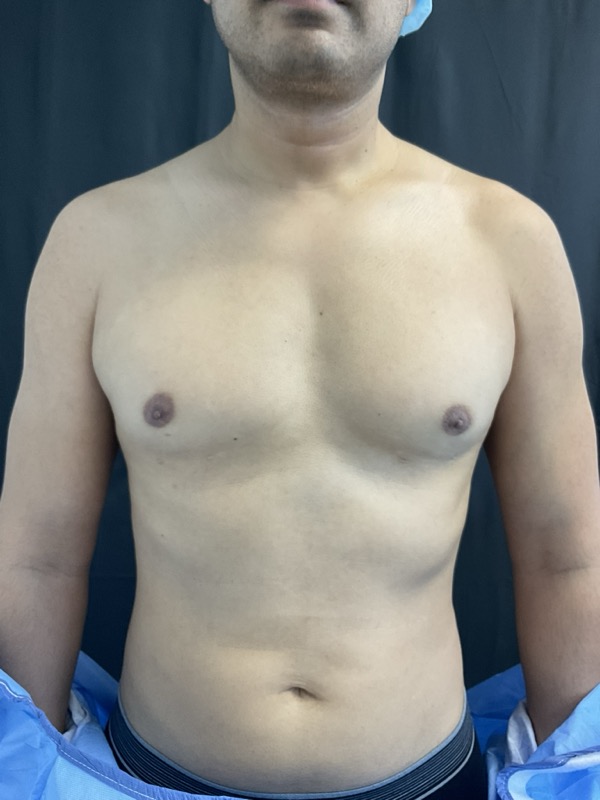 Gynecomastia Surgery Before & After Image