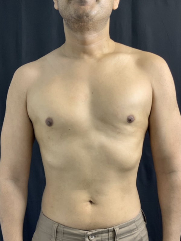 Gynecomastia Surgery Before & After Image