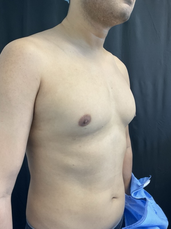 Gynecomastia Surgery Before & After Image