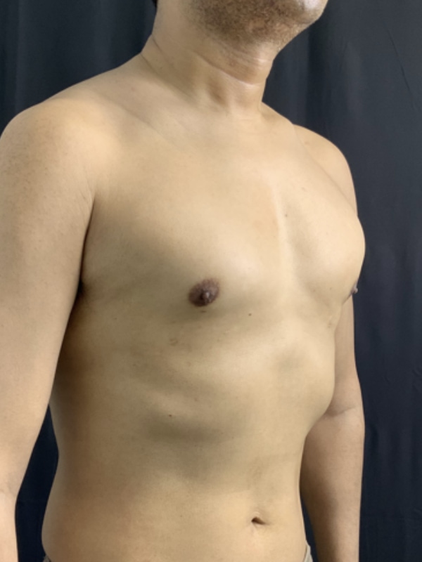 Gynecomastia Surgery Before & After Image