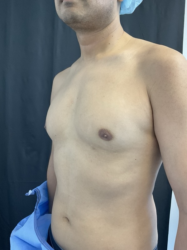 Gynecomastia Surgery Before & After Image