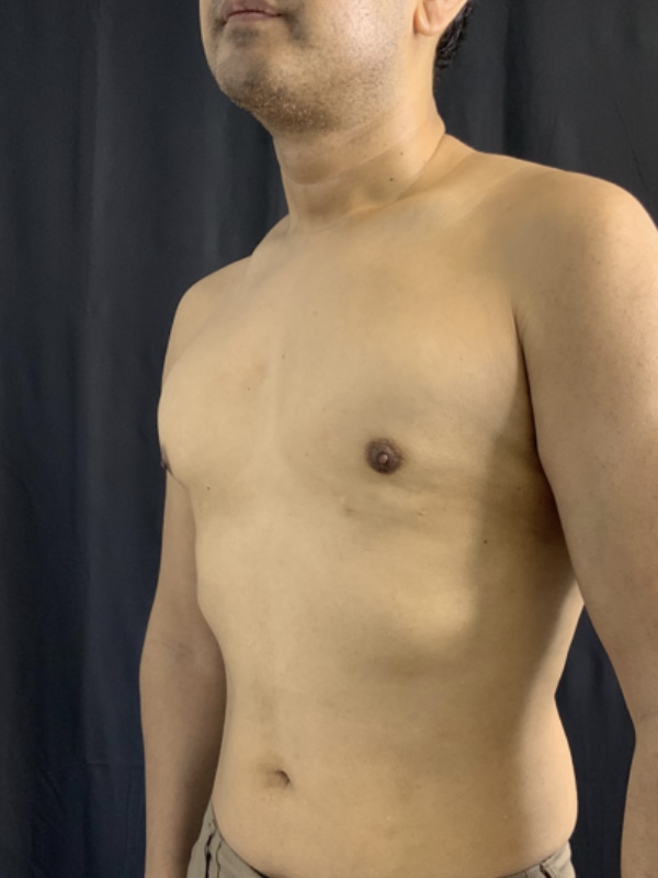Gynecomastia Surgery Before & After Image