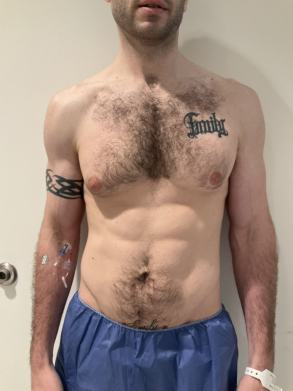 Gynecomastia Surgery Before & After Image