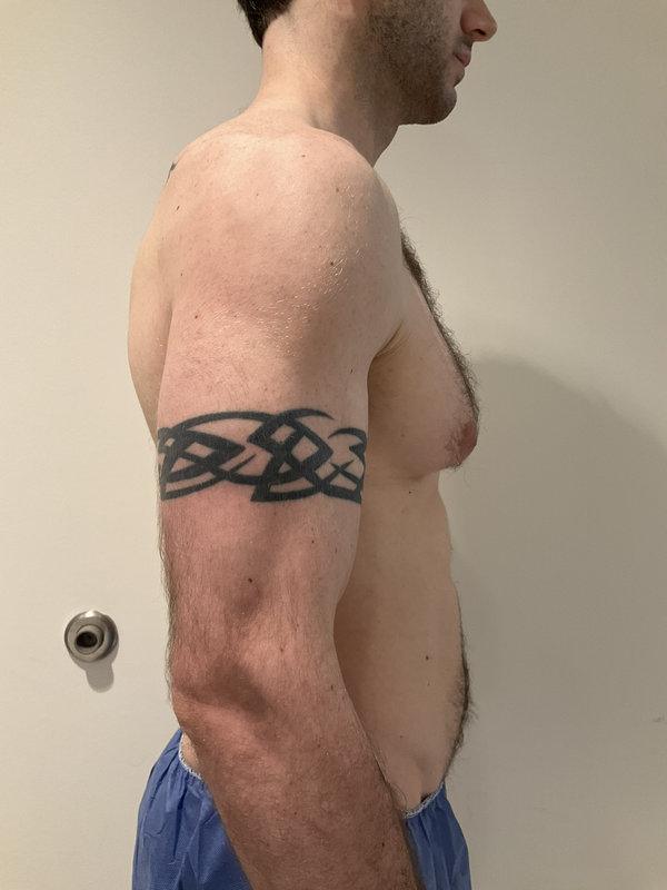 Gynecomastia Surgery Before & After Image