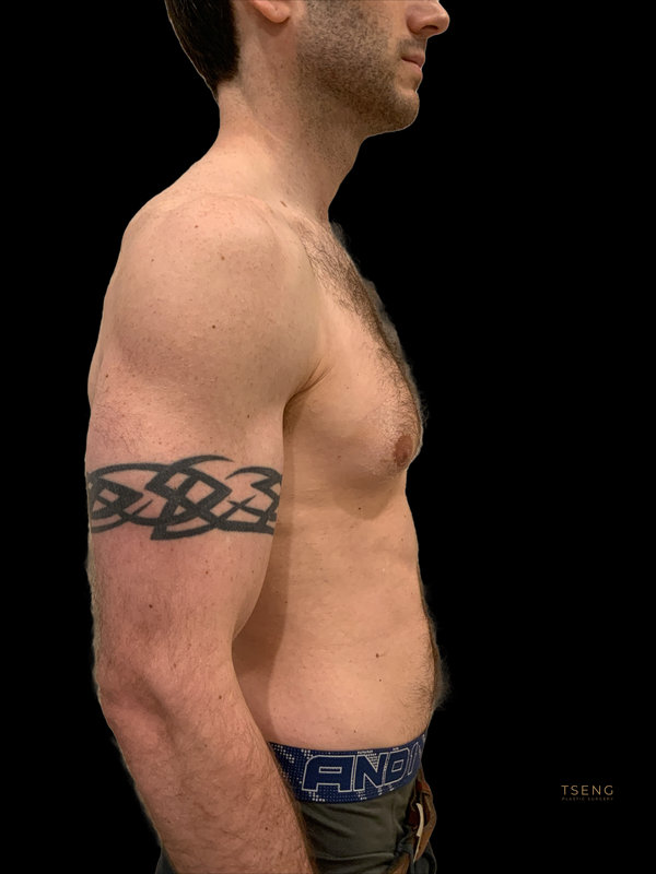 Gynecomastia Surgery Before & After Image