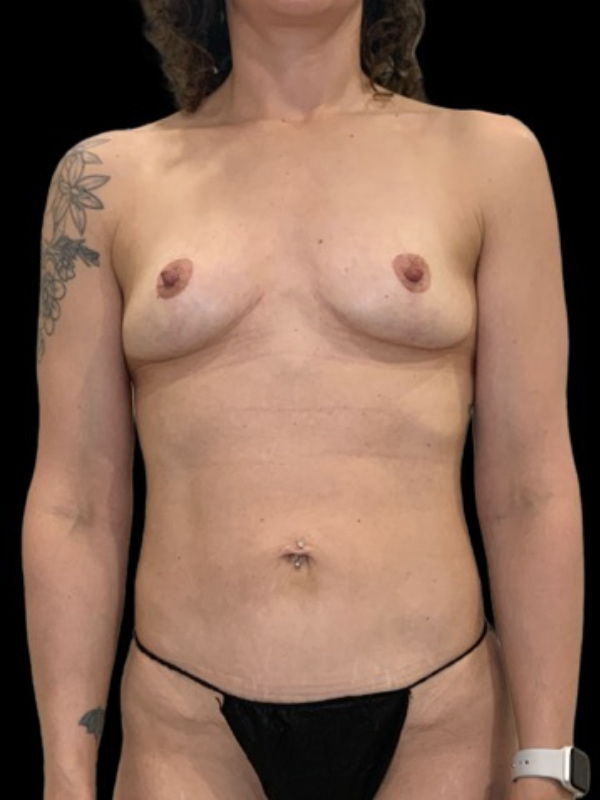 Renuvion Before & After Image