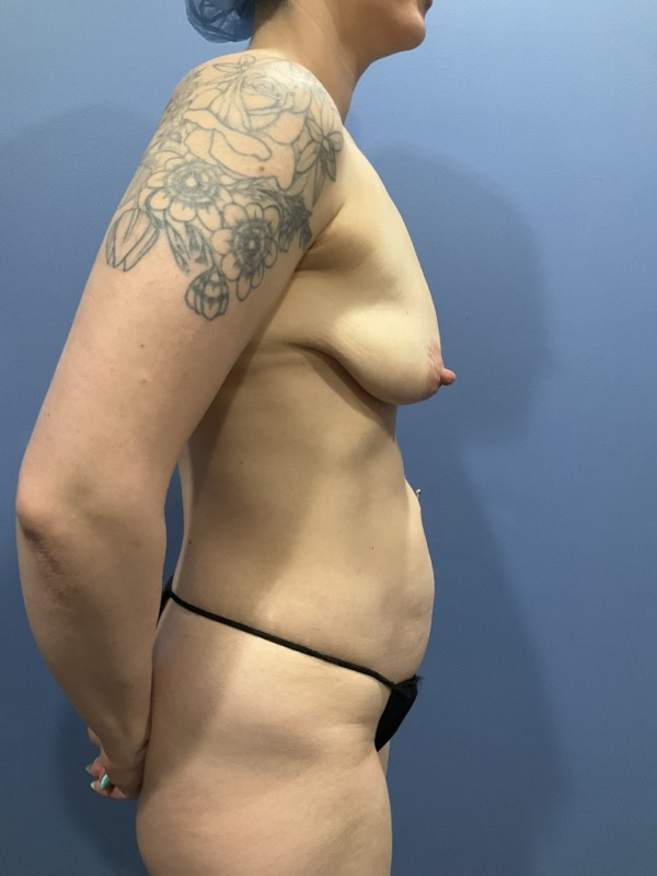 Renuvion Before & After Image