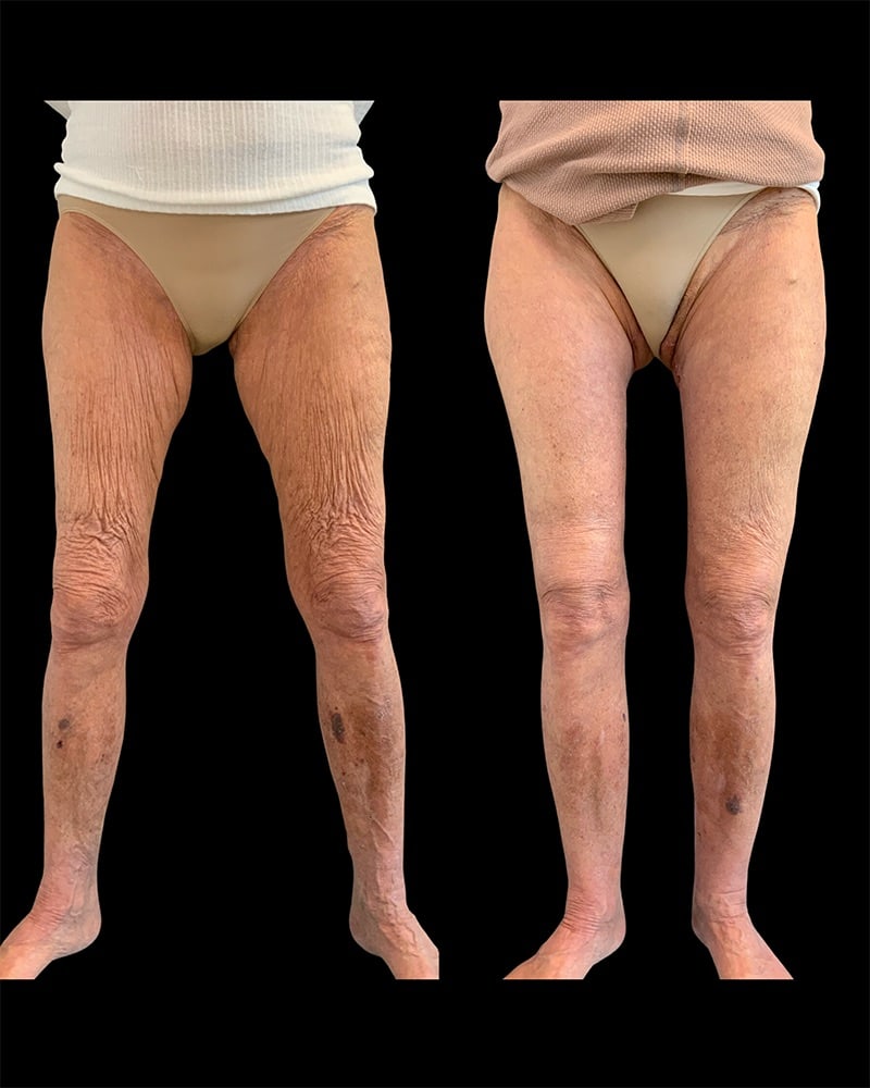 Thigh Lift Before & After Image