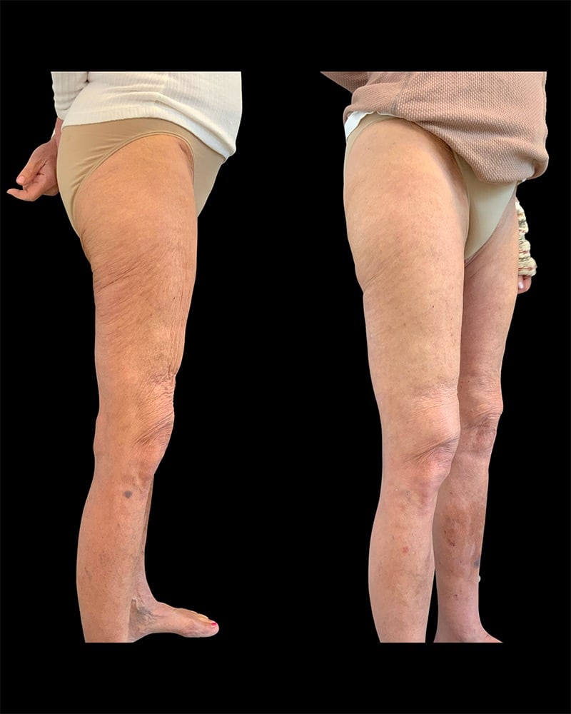 Thigh Lift Before & After Image