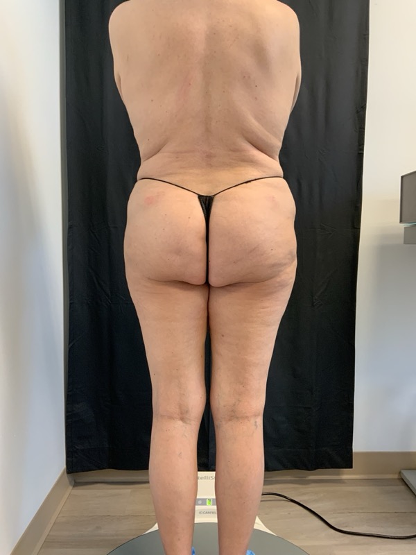 Thong Lift Before & After Image