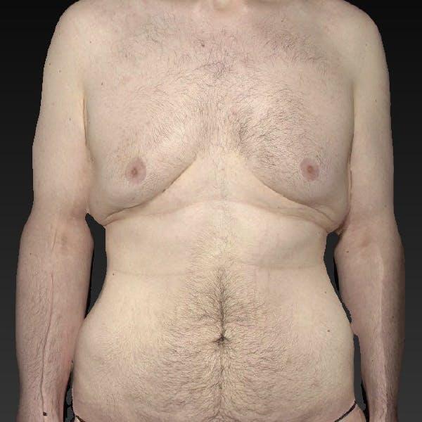 Tummy Tuck Before & After Image