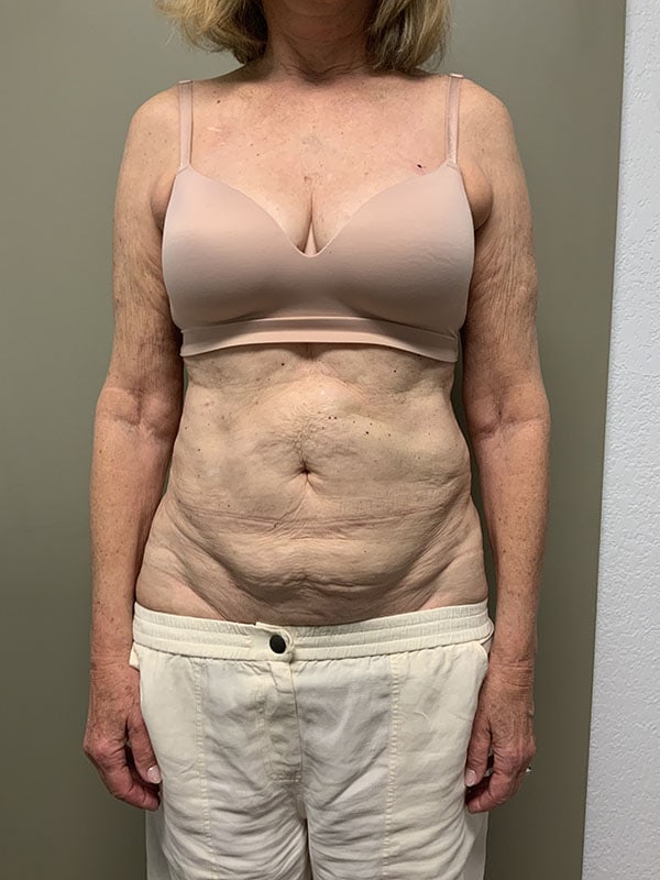 Tummy Tuck Before & After Image