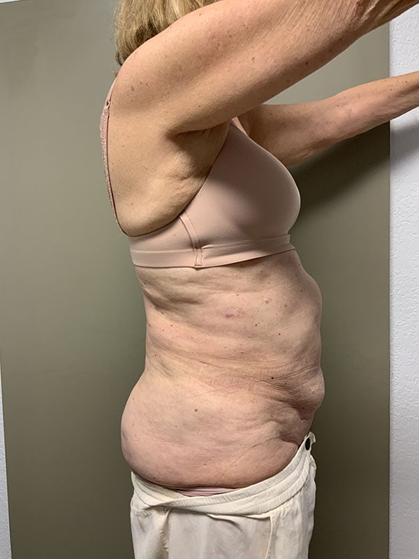 Tummy Tuck Before & After Image