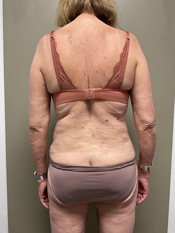 Tummy Tuck Before & After Image