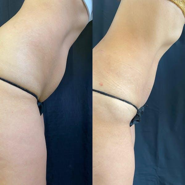 Tummy Tuck Before & After Image