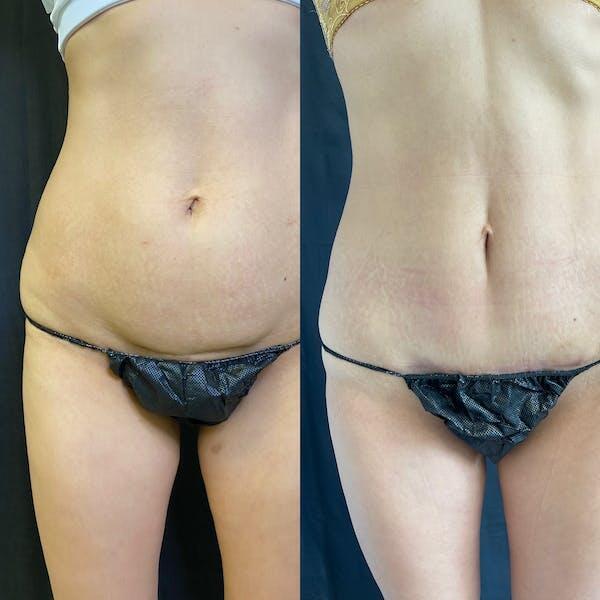 Tummy Tuck Before & After Image