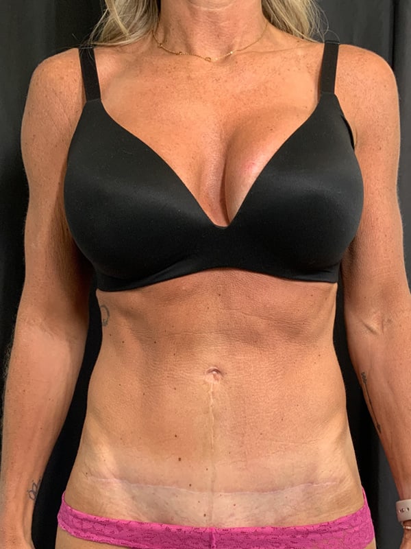 Tummy Tuck Before & After Image