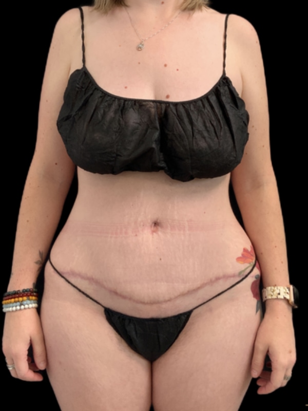 Tummy Tuck Before & After Image