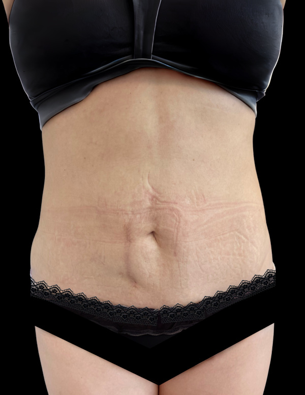 VASER HD Liposuction Before & After Image