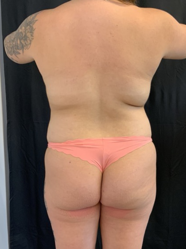 VASER HD Liposuction Before & After Image