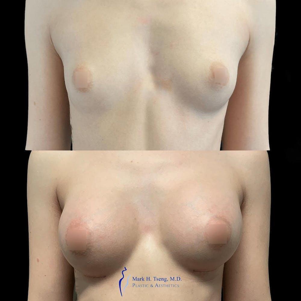 Breast Augmentations Before & After Image