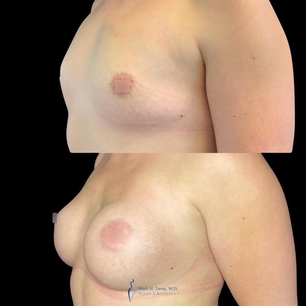 Breast Augmentations Before & After Image