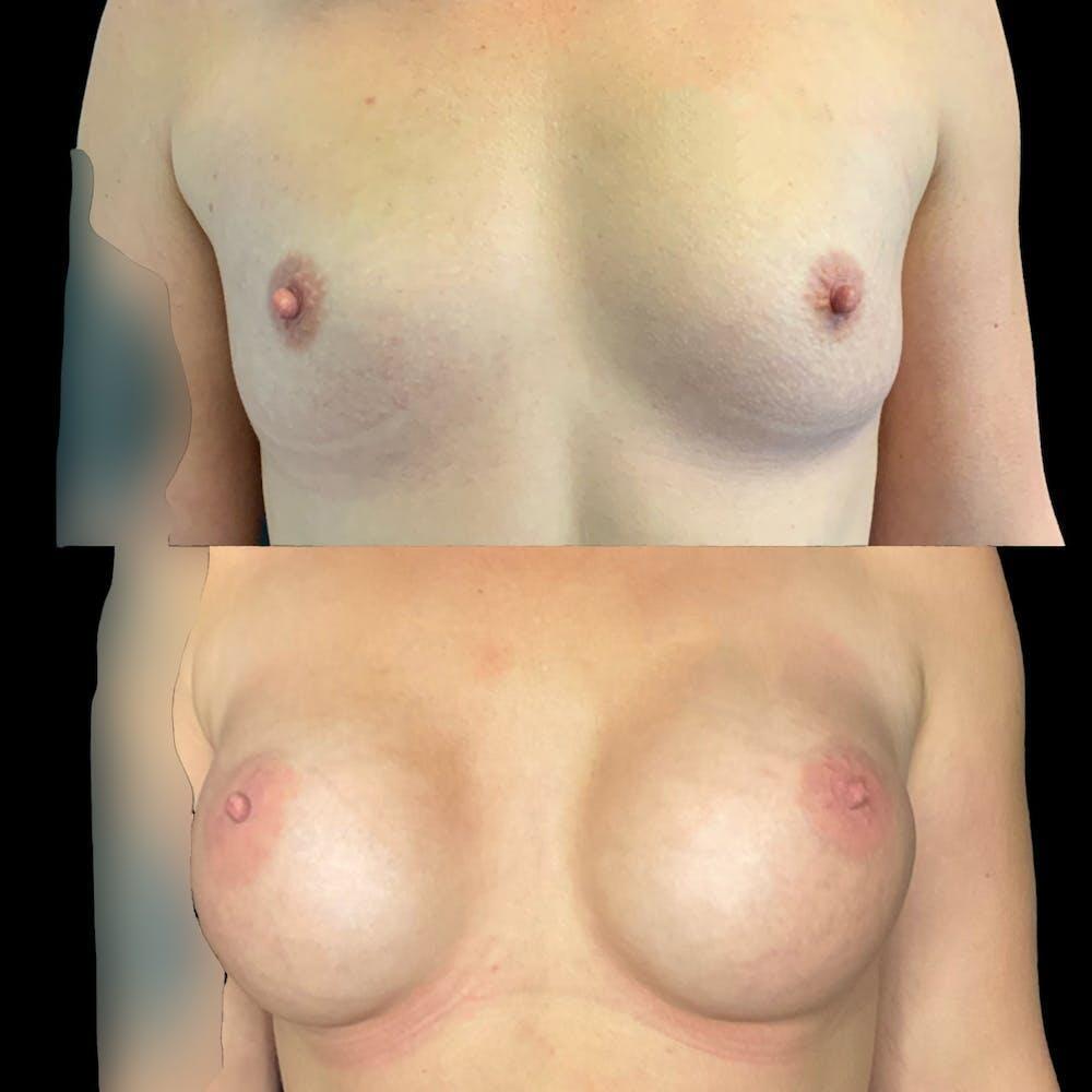 Breast Augmentations Before & After Image