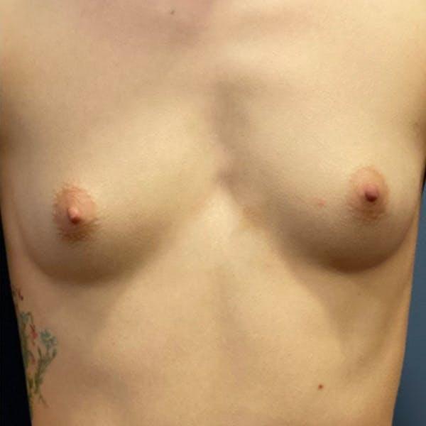 Breast Augmentations Before & After Image