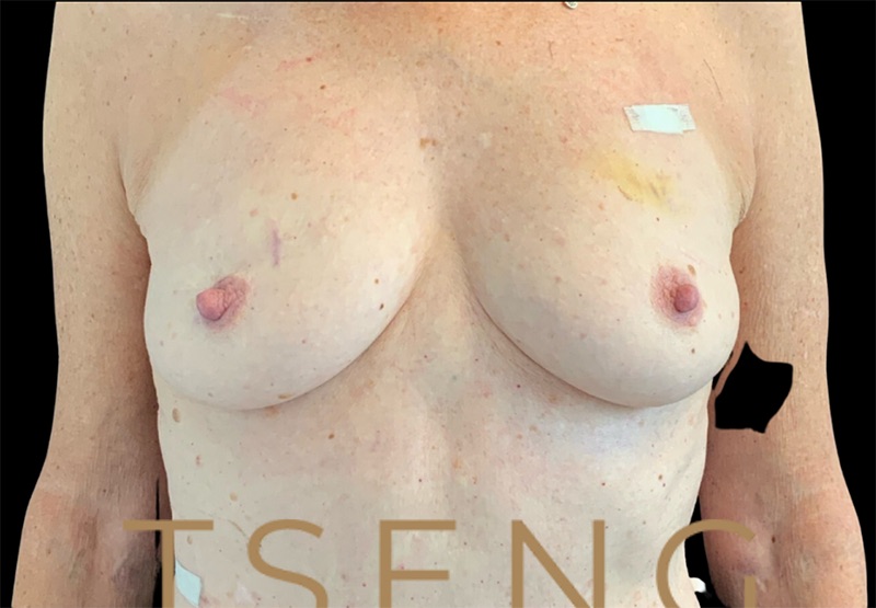 Breast Augmentations Before & After Image