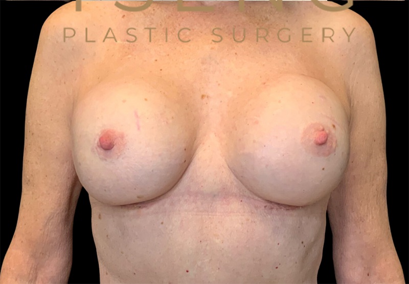 Breast Augmentations Before & After Image