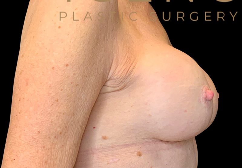 Breast Augmentations Before & After Image