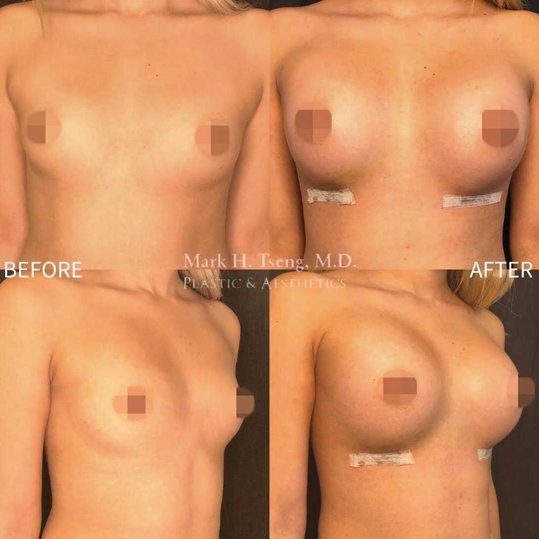Breast Augmentations Before & After Image