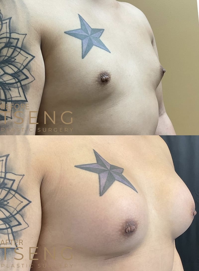 Breast Augmentations Before & After Image