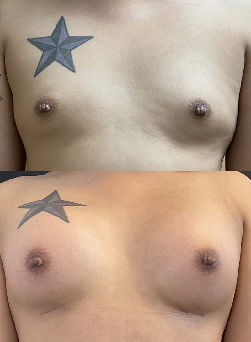 Breast Augmentations Before & After Image