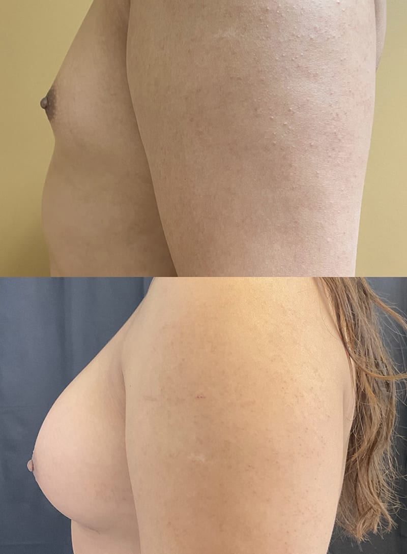 Breast Augmentations Before & After Image