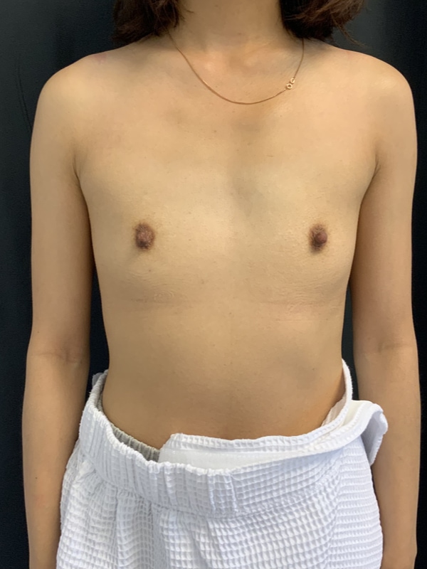 Breast Augmentations Before & After Image