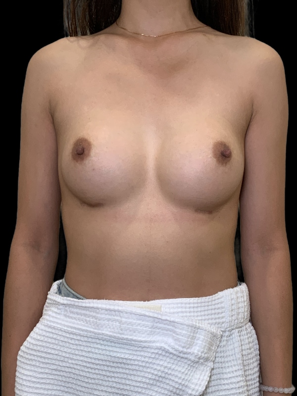 Breast Augmentations Before & After Image