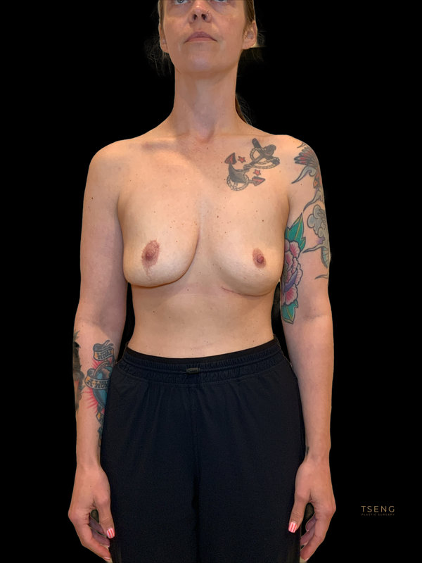 Breast Implant Removal Before & After Image