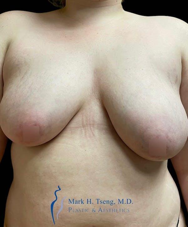 Breast Lift Mastopexy Before & After Image