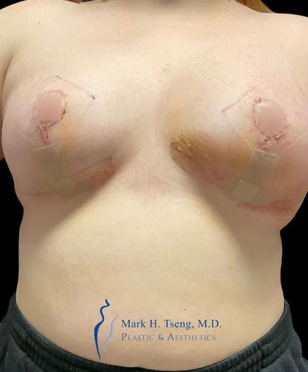 Breast Lift Mastopexy Before & After Image