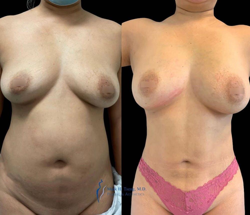 Fat Transfer Breast Augmentation Before & After Image