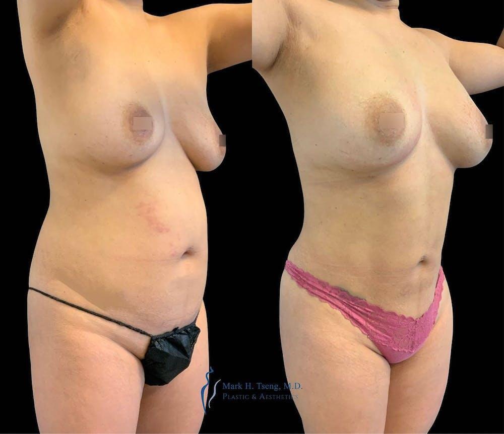 Fat Transfer Breast Augmentation Before & After Image