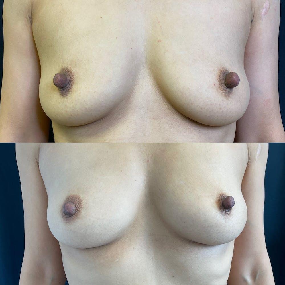 Fat Transfer Breast Augmentation Before & After Image