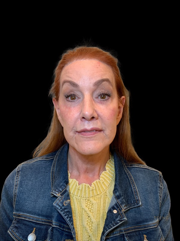 Brow lift Before & After Image