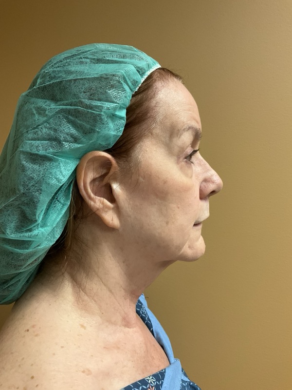 Brow lift Before & After Image