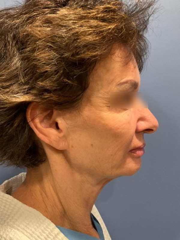 Brow lift Before & After Image