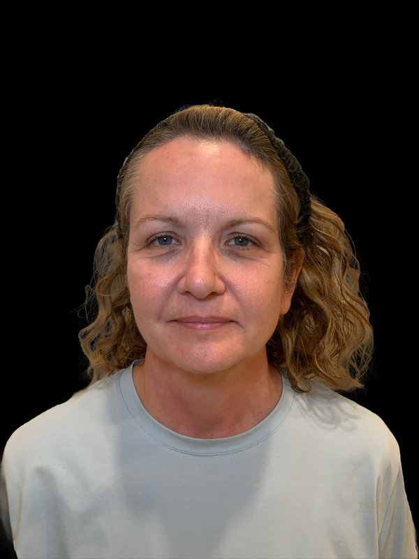 Brow lift Before & After Image